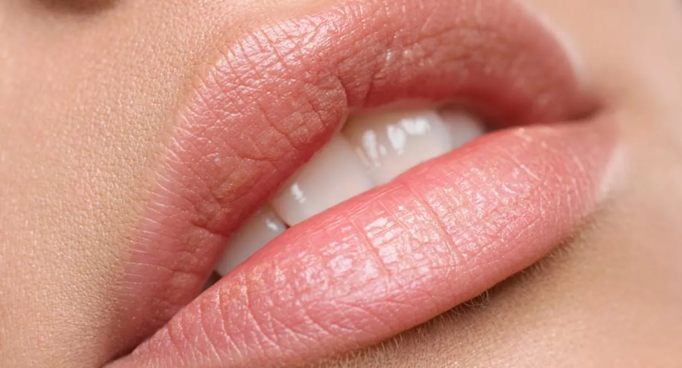 Petites lèvres, lèvres deshydratées, ridules des lèvres Petites lèvres, lèvres deshydratées, ridules des lèvres